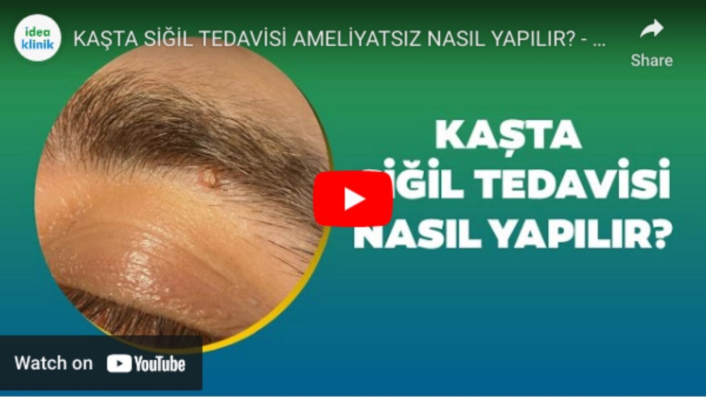 siğil tedavisi