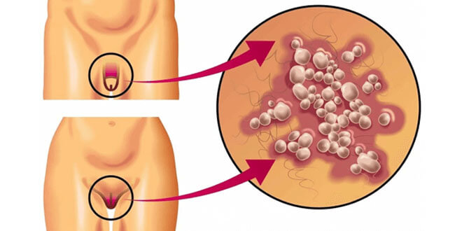 Anal ve genital siğil