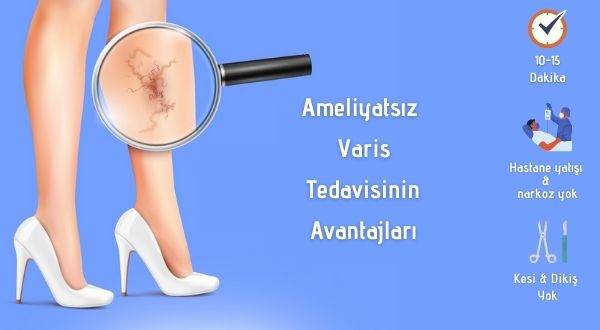 ameliyatsız varis tedavisi avantajları