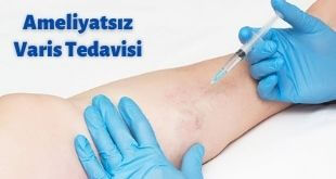 ameliyatsız varis tedavisi