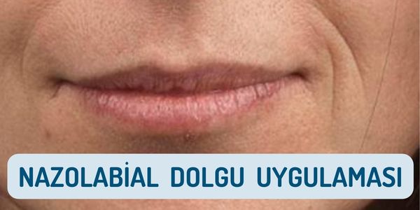 NAZOLABİAL DOLGU UYGULAMASI